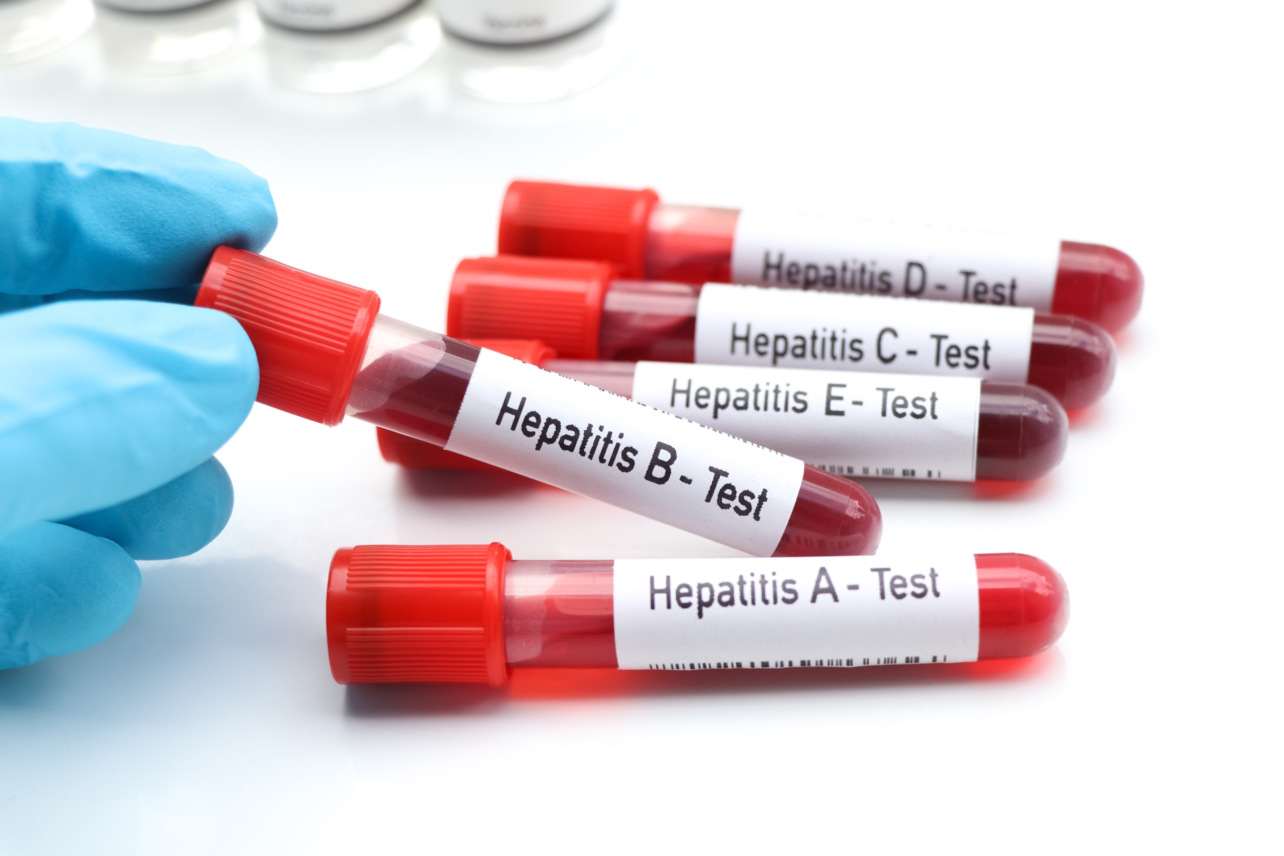 Hepatitis,Test,To,Look,For,Abnormalities,From,Blood,,Scientific,Experiment